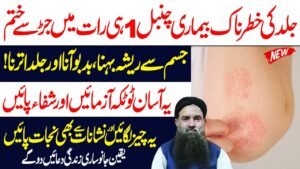 Simple Home Remedy to Relieve Psoriasis – Remove Itching, Odor, and Skin Flakes Naturally maxresdefault-88